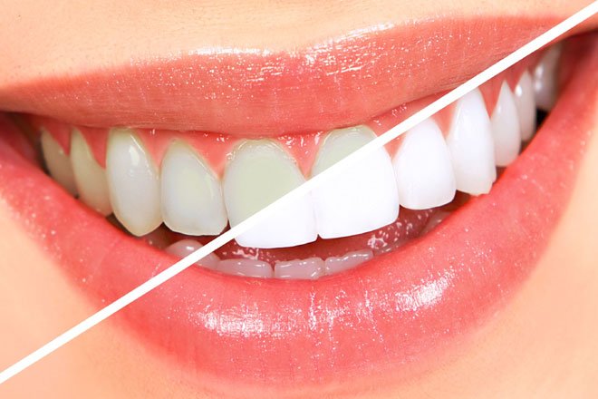 Sapphire-Teeth-Whitening