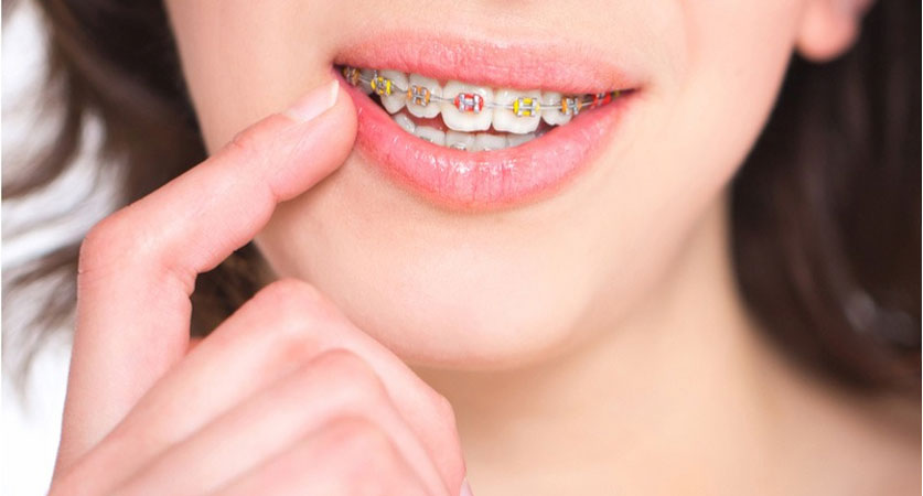 braces colors for girl