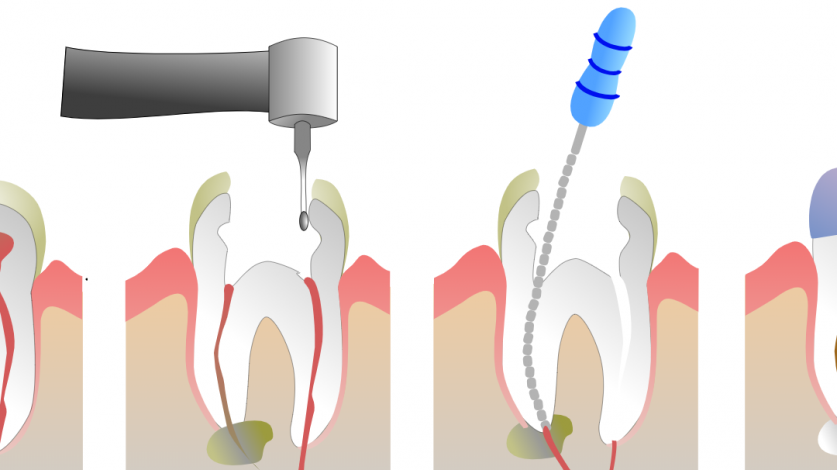 root canal dentist