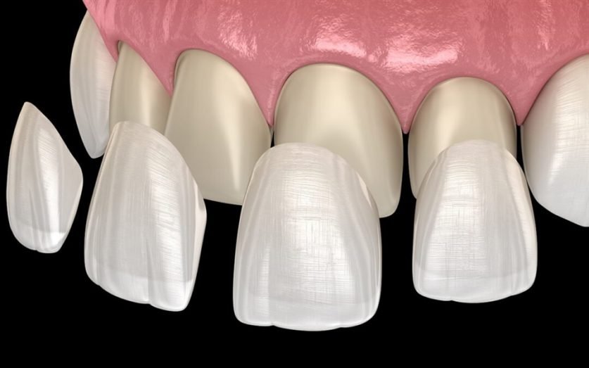 Lumineers Veneers