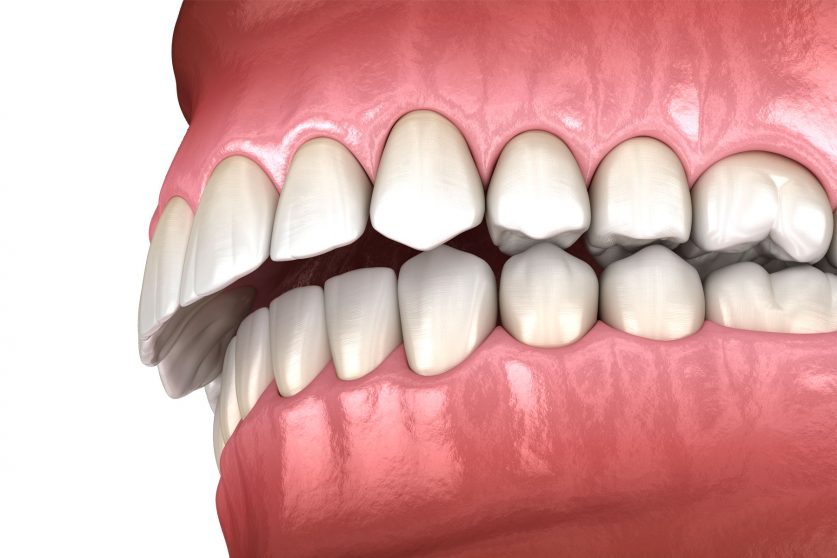 overbite braces