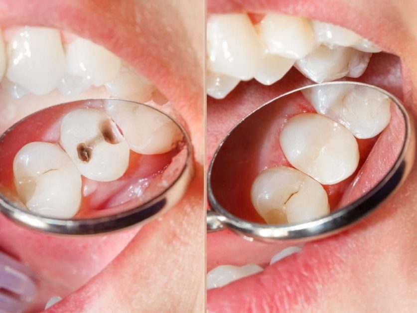 Composite Dental Fillings