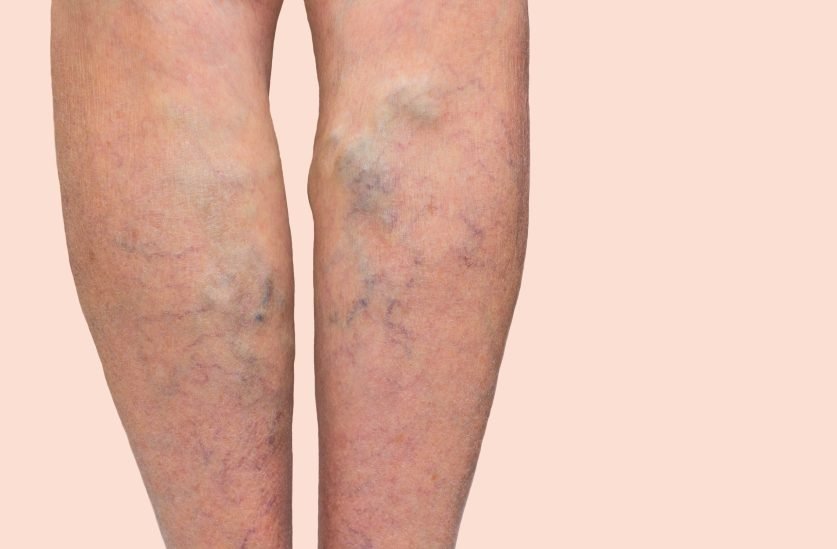 What Complications Can Occur During Varicose Veins? What Complications Can Occur During Varicose Veins?