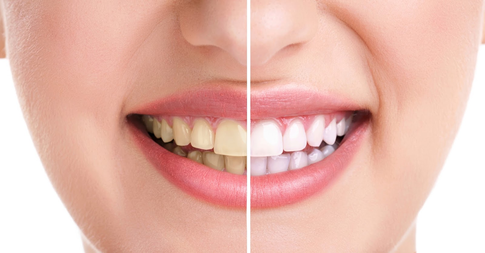 Teeth Whitening Dentist