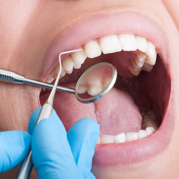 teeth cleaning Miami