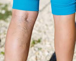 Are varicose veins covered by insurance