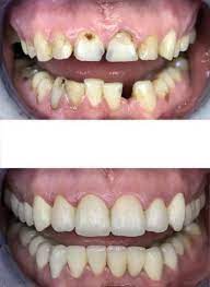 teeth Reconstruction