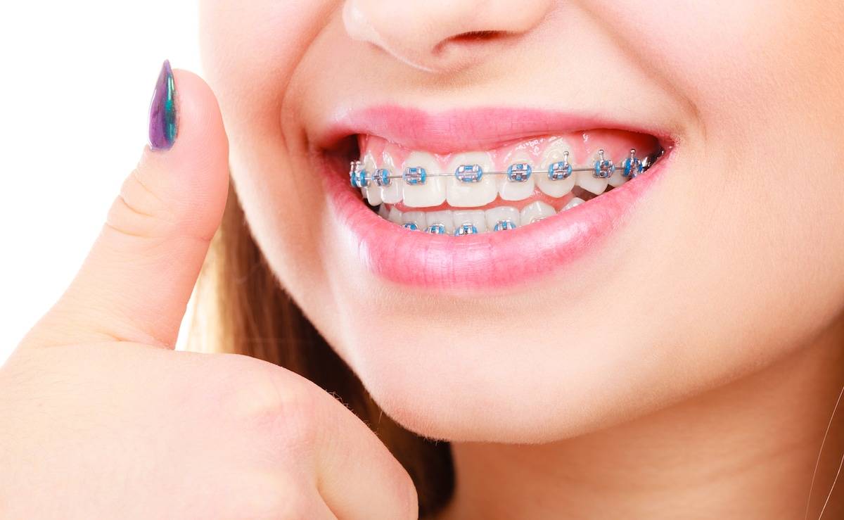 Braces with missing teeth