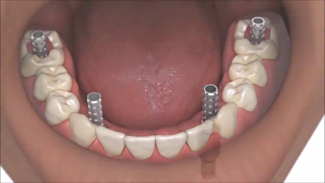 Full mouth dental implants