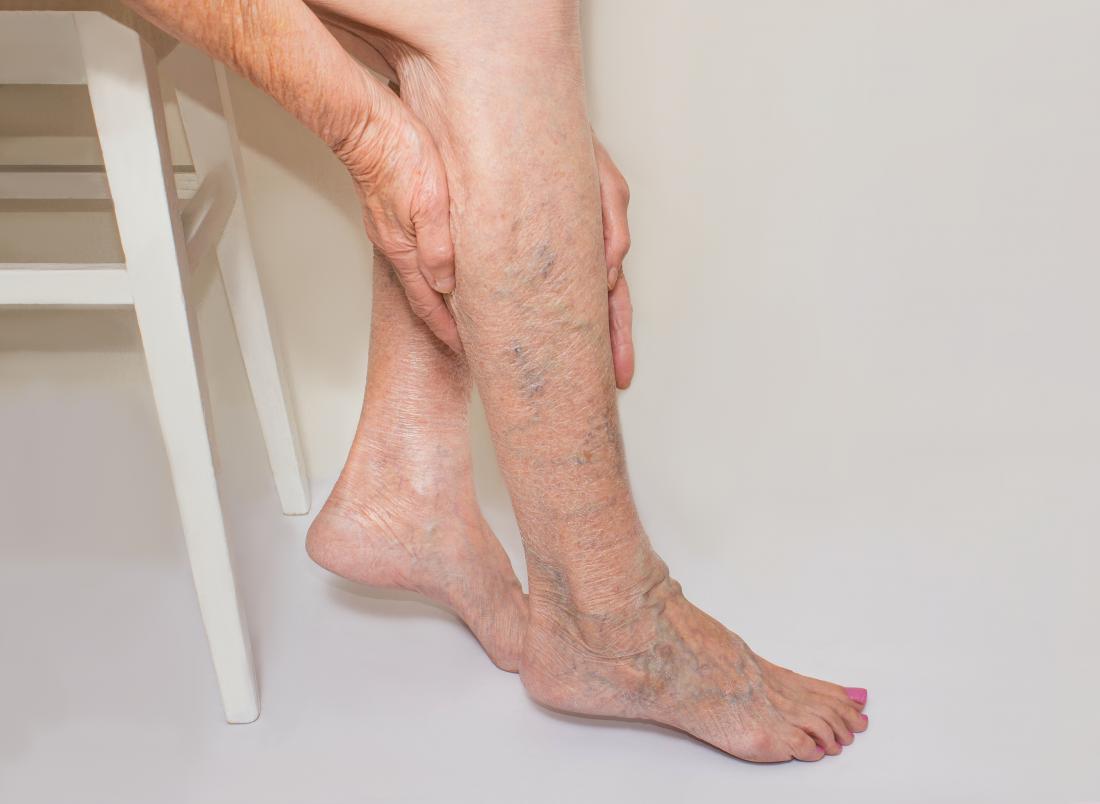 What are the Treatment Options for Varicose Veins