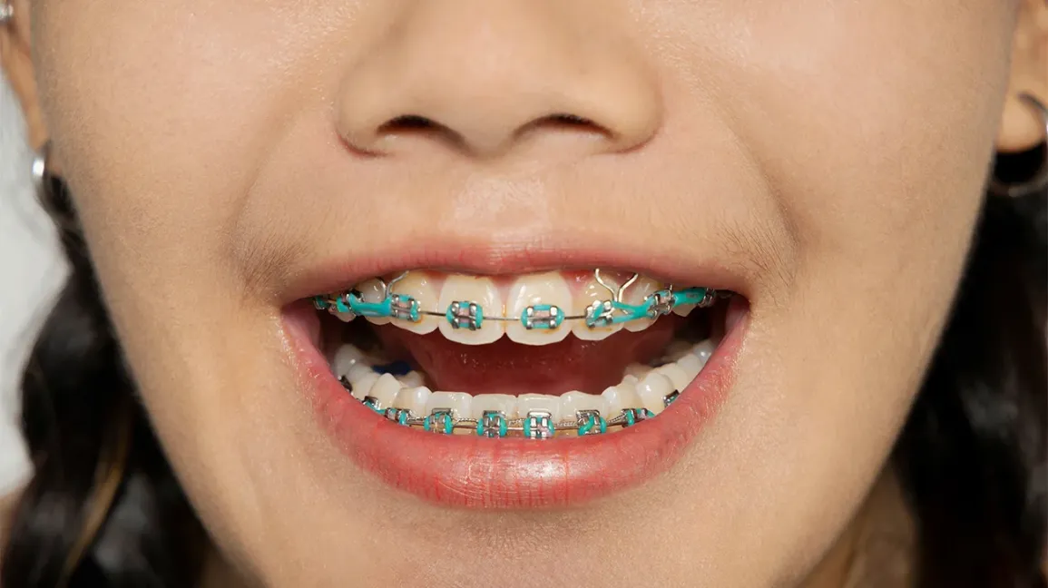 Braces Colors